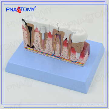 Modelos de dientes dentales PNT-0528cc y modelo de comunicación de implantes para dentista